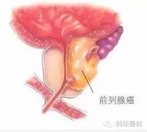 前列腺癌超强科普贴,耐受性前列腺癌治疗已经出现曙光
